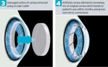 ลักษณะของเปลี่ยนกระจกตาเทียม